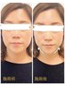 【期間限定モニター様限定】小顔美容鍼　45分　3,900円