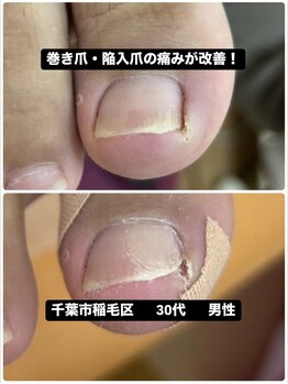 痛い原因は巻き爪・陥入爪でした