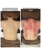 チョアチョア 札幌すすきの店(CHOA-CHOA)/背中カッサでコリに感動の効果