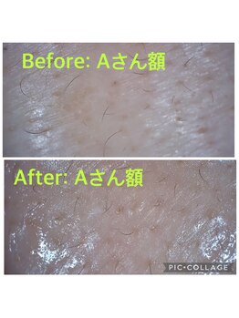 バルーサヤ 吉祥寺(Baru Saya)/Before-After Aさん額（４０代）