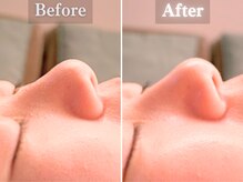 ボーンオム(Born Homme)/毛穴洗浄＋美容液導入：20代女性