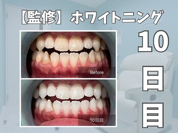 エックス(X)/【監修】ホワイトニング