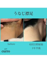 アクト クロ(ACT curro)/【うなじ襟足】脱毛施術例