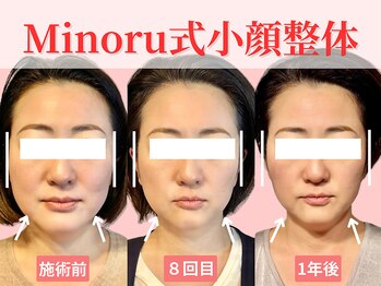 フレキシボディ(FlexiBody)/小顔施術ビフォーアフター #22