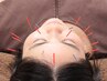 【お顔のたるみ/ほうれい線】小顔リフトアップ♪リンパ+美容鍼灸 70分