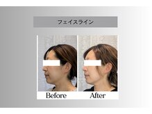 フェイシャルサロン セレスタイト/2カ月後の継続効果