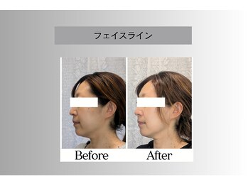 フェイシャルサロン セレスタイト/2カ月後の継続効果