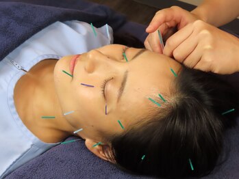 ビースタイル(B-style)/【美容鍼灸】電気美容鍼施術