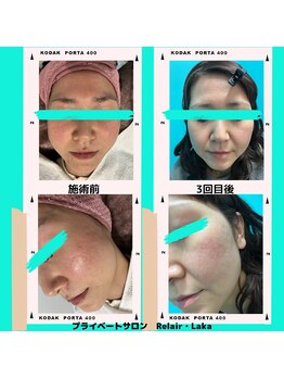 リレア ラカ(Relair Laka)/VERUNAハーブピーリング