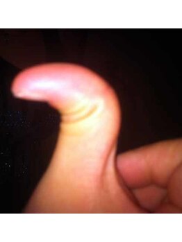 スイクウ ネオ(neo)/ツボ押しで曲がった指