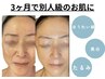 【3カ月で別人級|肌悩み改善ケア】幹細胞導入+リフトアップフェイシャル80分