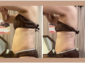 リムアール(Limh R)/ビフォーアフター