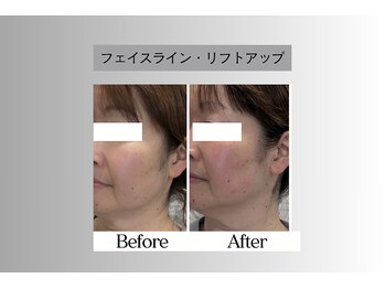 フェイシャルサロン セレスタイト/2カ月後の継続効果