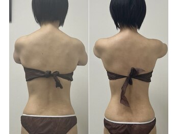 ラディアボディ四十瀬の写真/【ハミ肉・ぽっこりお腹・下っ腹】徹底アプローチ!