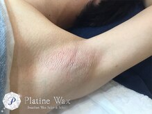 プラチナワックス(Platine Wax)/メンズ★ワックス脱毛