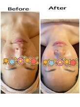 ハレル(Hareru)/アキュライズフェイシャル 120分