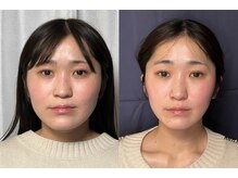 美容整体 アルマ/小顔矯正8回目