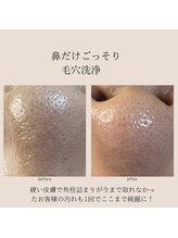 キッキー(Kicky)/鼻だけごっそり毛穴洗浄（鼻だけ