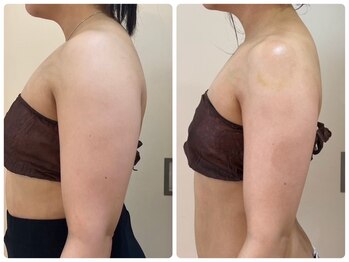 エイシスグロウ(asis glow.)/効果写真