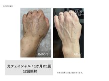 フェレザ 新潟(Felleza)/光フェイシャル女性スタッフ施術