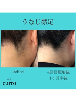 アクト クロ(ACT curro)/【うなじ襟足】脱毛施術例