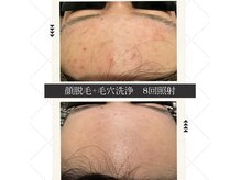 モアトゥインクル 福山宮通り店(MORE twinkle)の雰囲気（脱毛しながら肌改善(^^)自信が持てる美肌に☆#顔脱毛#ニキビ）