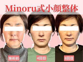 フレキシボディ(FlexiBody)/小顔施術ビフォーアフター #23