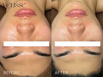 Velisse 表参道店【ヴェリス】《毛穴/肌質改善/ハーブピーリング/ニキビケア》/