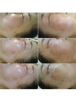 サロン ド フェミニスト(Salon de フェミニスト)/肌レベルもUP♪