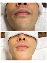 ヴァイオス 新宿店(VIOS)/◆ヒゲ脱毛【before/after】