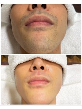 ヴァイオス 新宿店(VIOS)/◆ヒゲ脱毛【before/after】