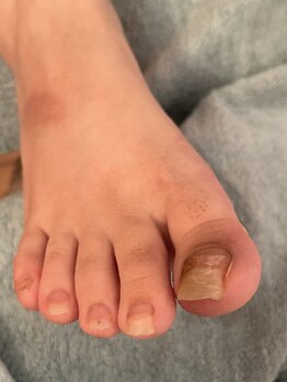 ネイルサロンアンドスクール シーグリーン(SEAGREEN)/【お悩み事例】爪の剥離