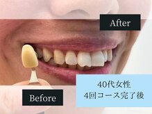 ホワイトニングカフェ 岸和田店(WhiteningCafe)/◎歯のホワイトニング施術写真◎