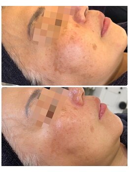 ビーエスアクアビューティー/ハイドラ＋ヒト幹細胞上層液導入