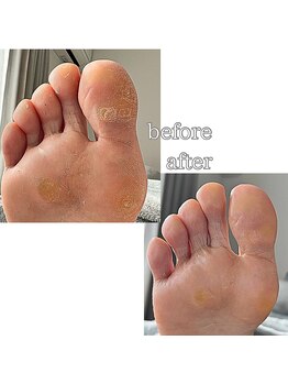 フットミー(foot mii)/