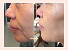 人気のたるみケア、小顔！毛穴洗浄、ブライダルも♪