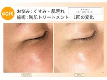 ムーンサン(Moon sun)/40代　陶肌トリートメント1回