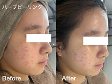 プティ 横浜店(Petit)/赤み/肌弱さんにも◎