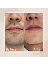 ルミナ(Lumina)/メンズ脱毛