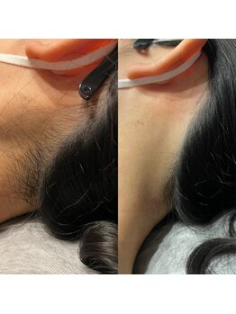 エイチビューティーラボ(h Beauty labo)/うなじ脱毛