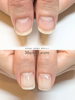 マリーロール 梅田店(Marie Laure)/自爪育成/深爪矯正/ネイルケア