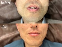 ボス 津店(BOSS)/【メンズ脱毛/ヒゲ脱毛】