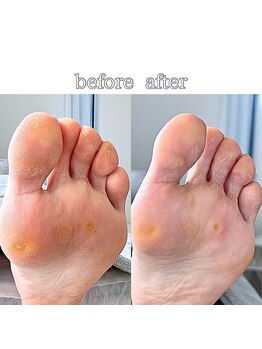 フットミー(foot mii)/