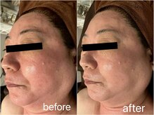 リヴェイラ(RIVEIRA)/グリーンピール5days