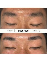 ナークス(NARX)/【眉毛脱毛】ビフォーアフター