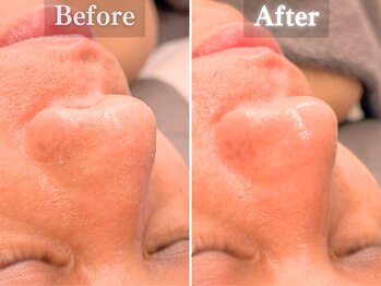 ボーンオム(Born Homme)/毛穴洗浄＋美容液導入：40代男性