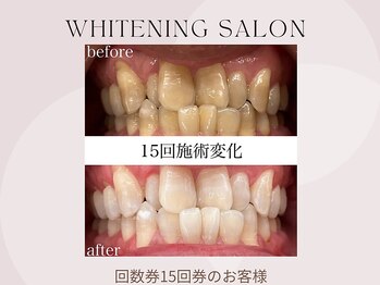 ホワイト つくば店(WHITE)/【20トーンup】14照射後のお客様