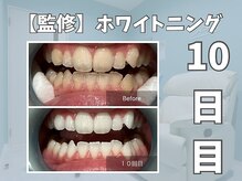 エックス(X)/【監修】ホワイトニング