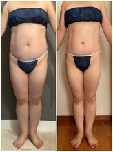 エミニー バイ エルズ(Eminy by L★s)/40代　セルゼロ全身　24回