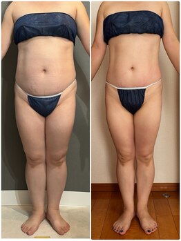 エミニー バイ エルズ(Eminy by L★s)/40代 セルゼロ全身 24回